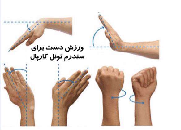 ورزش سندروم تونل کارپال