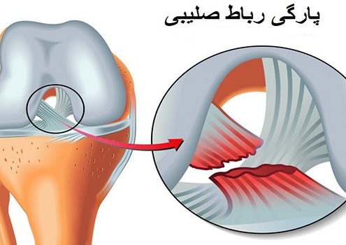 رباط صلیبی قدامی