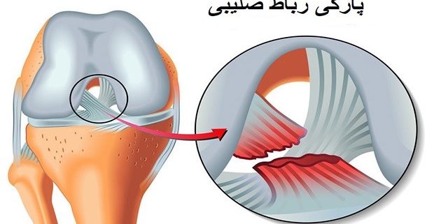 رباط صلیبی قدامی