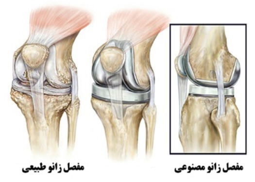 جراحی تعویض مفصل زانو