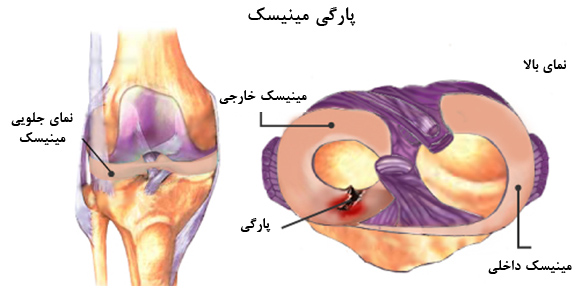 عکس پارگی مینیسک زانو