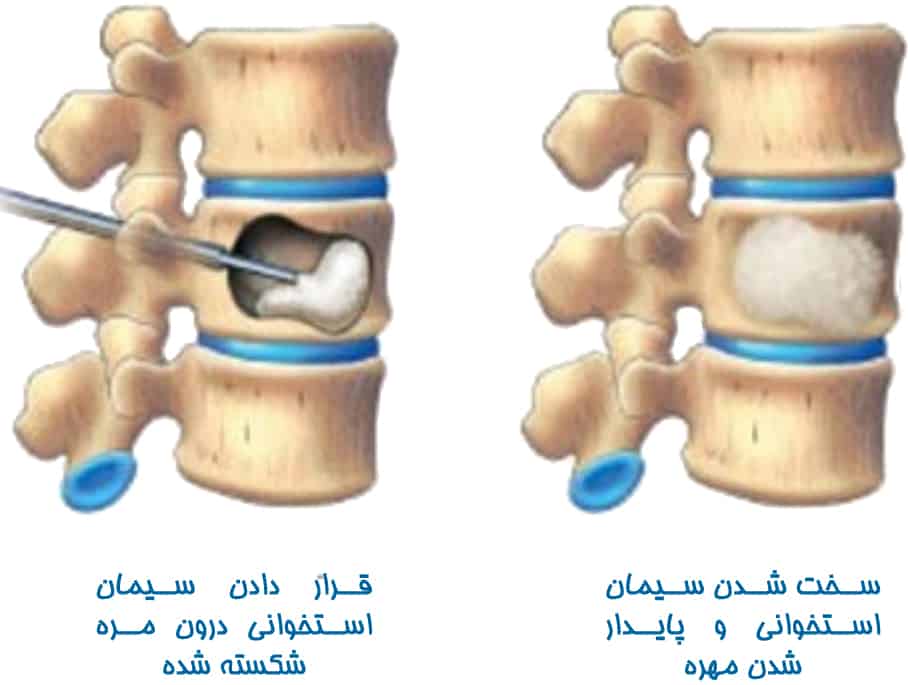 تزریق سیمان به کمر