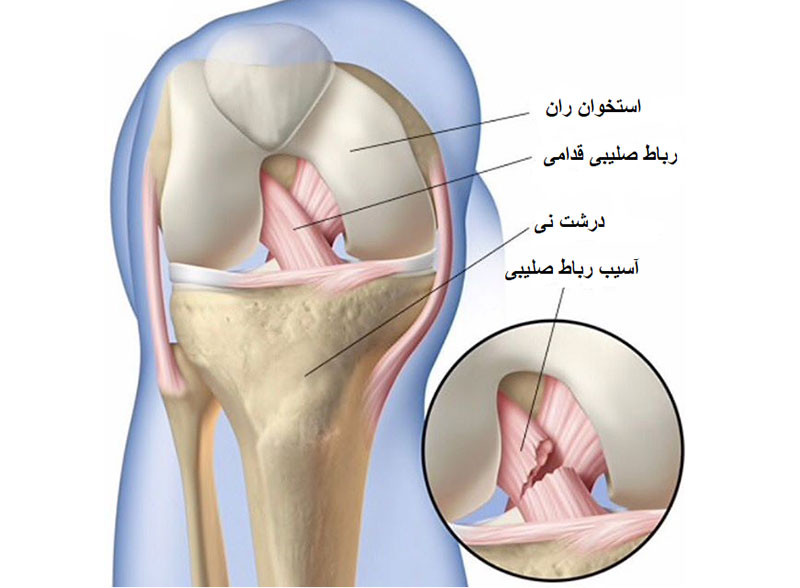 اندازه رباط صلیبی