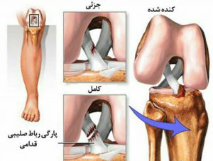 عکس پارگی رباط صلیبی