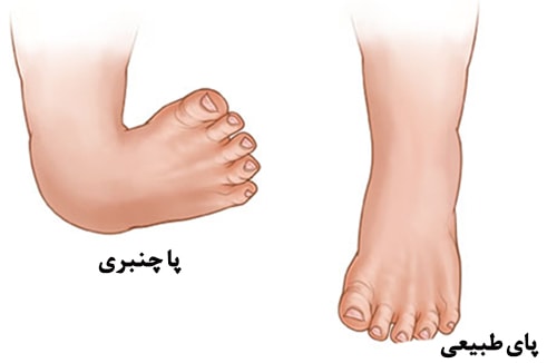 پا چنبری یا کلاب فوت