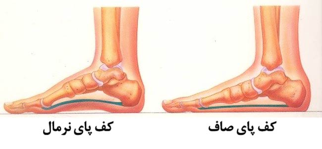 فوق تخصص کف پا