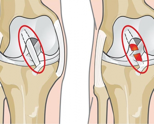 علائم پارگی رباط صلیبی زانو