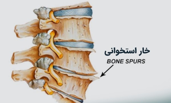 درمان خار استخوانی کمر