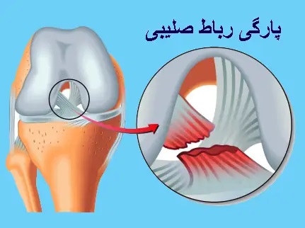 عکس پارگی رباط صلیبی قدامی