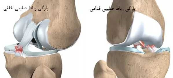 رباط صلیبی خلفی