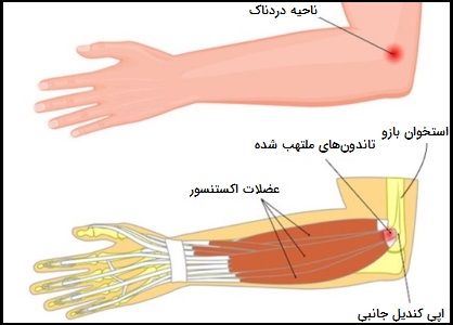 عکس تاندون دست