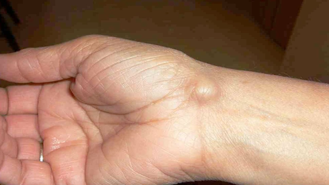 عکس کیست مچ دست