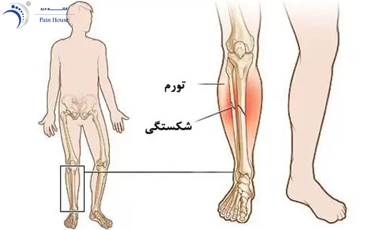 شماتیک شکستگی ساق پا