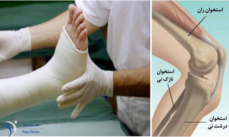 شکستگی ساق پا