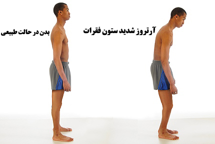 ایا روماتیسم ستون فقرات خطرناک است