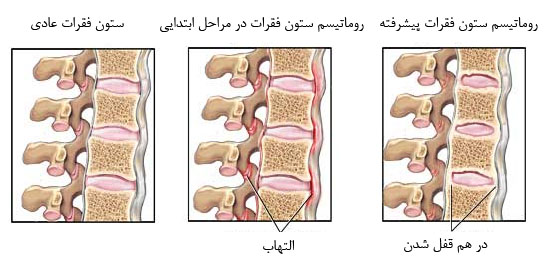عکس روماتیسم ستون فقرات