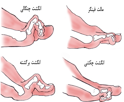 عکس انگشت چکشی