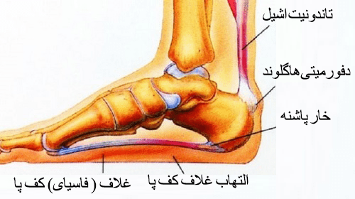 التهاب کف پا