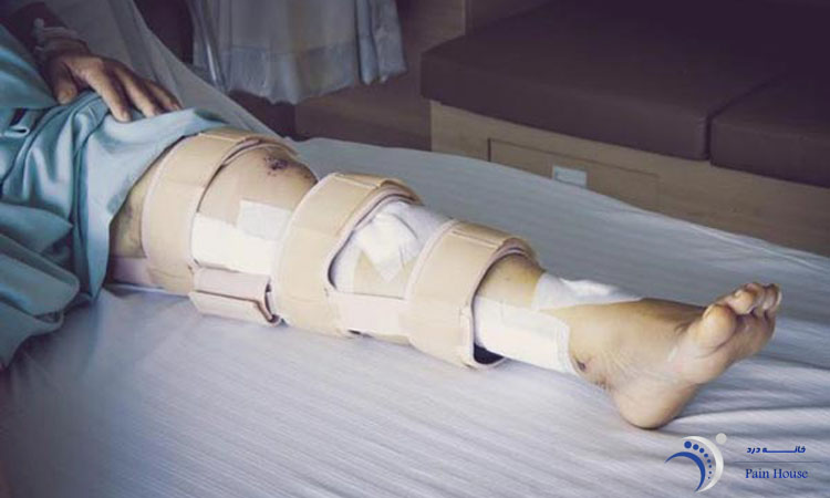گچ گیری شکستگی ساق پا