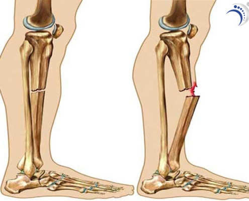 درمان شکستگی ساق پا
