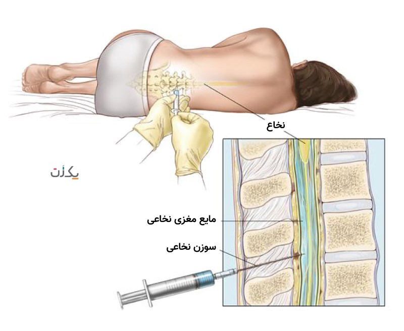 علت کمر درد بعد از بی حسی نخاعی