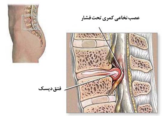 عکس فتق دیسک