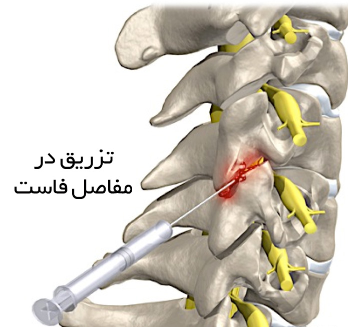 درمان التهاب مفاصل کمر