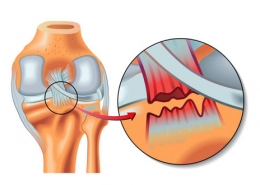 آسیب لیگامانی چیست