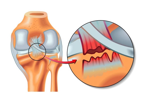 آسیب لیگامانی چیست