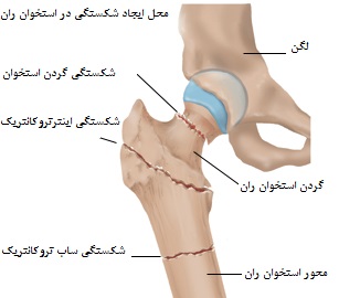 شکستگی استخوان فمور لگن