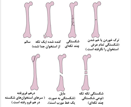 انواع شکستگی استخوان
