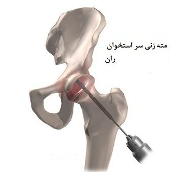 ایا بیماری پرتس درمان دارد
