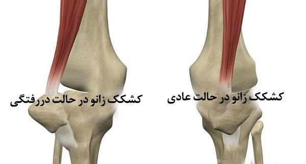 عکس در رفتگی زانو
