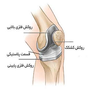 تعویض مفصل زانو در کودکان