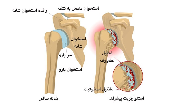 عکس آرتروز شانه