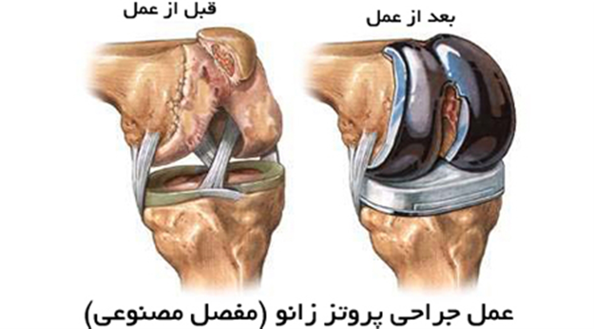 پروتز زانو