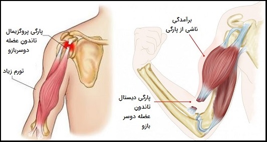 عکس تاندون های بازو