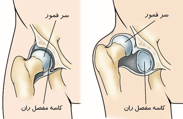 عکس دیسپلازی مفصل ران