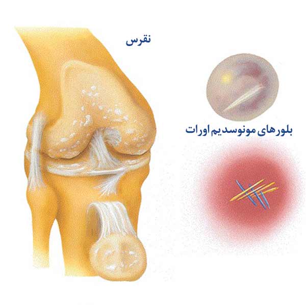 عکس نقرس زانو