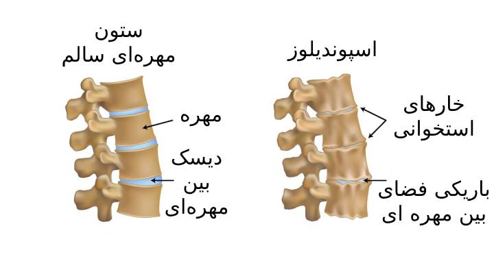 اسپوندیلوز کمری و ستون فقرات چیست
