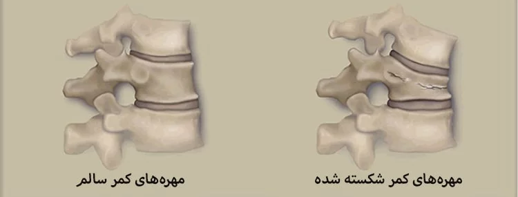 انواع شکستگی های مهره کمر