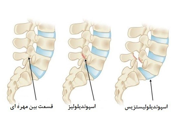 انواع در رفتگی مهره کمر