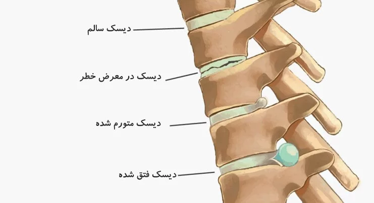 دیسک کمر چیست