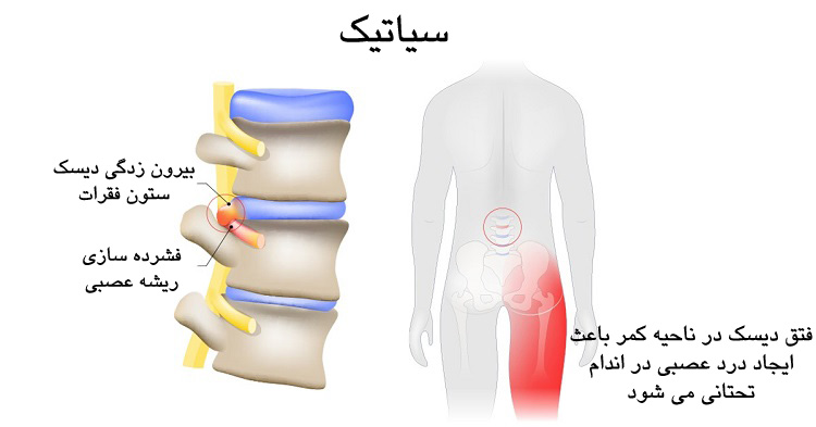 عوارض دیسک کمر