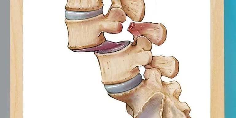 علائم در رفتگی مهره های کمر