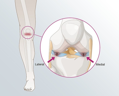 پارگی مینیسک زانو چگونه درمان میشود