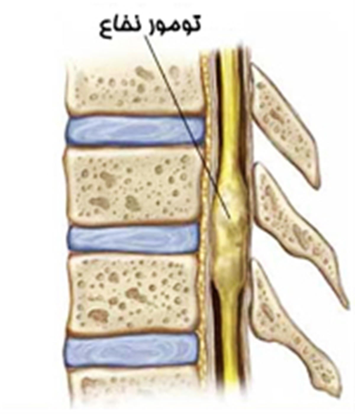 علائم تومور نخاعی