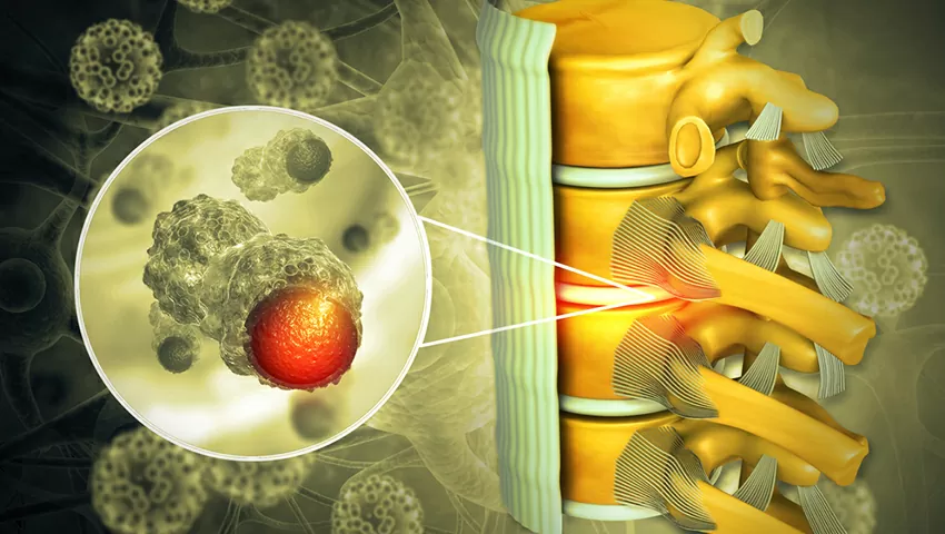 درمان سرطان ستون فقرات