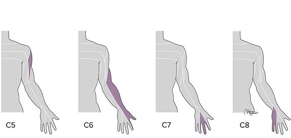 علائم دیسک گردن عصبی