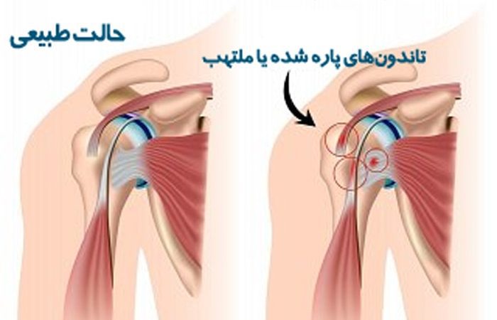 عکس تاندونیت شانه